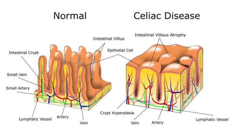New Drug Protects People With Celiac Disease From Gluten Damage in Clinical Trial