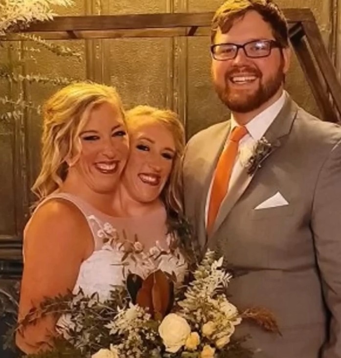 One Of These Conjoined Twins Got Married: And Everyone Is Asking The Same Questions!