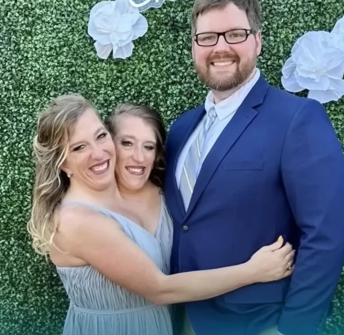 One Of These Conjoined Twins Got Married: And Everyone Is Asking The Same Questions!