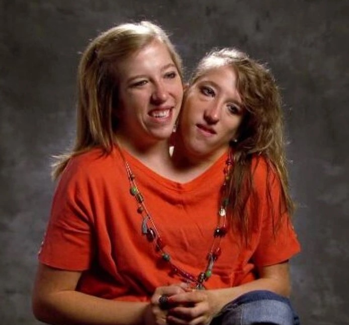 One Of These Conjoined Twins Got Married: And Everyone Is Asking The Same Questions!